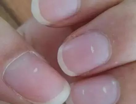 孩子指甲軟薄易斷、月牙少、長白點(diǎn)、豎紋是顯示身體有健康風(fēng)險(xiǎn)嗎？(圖6)