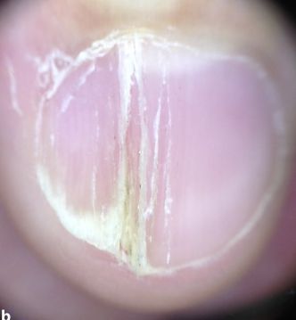 孩子指甲軟薄易斷、月牙少、長白點(diǎn)、豎紋是顯示身體有健康風(fēng)險(xiǎn)嗎？(圖11)