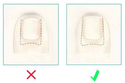 孩子指甲軟薄易斷、月牙少、長白點(diǎn)、豎紋是顯示身體有健康風(fēng)險(xiǎn)嗎？(圖13)
